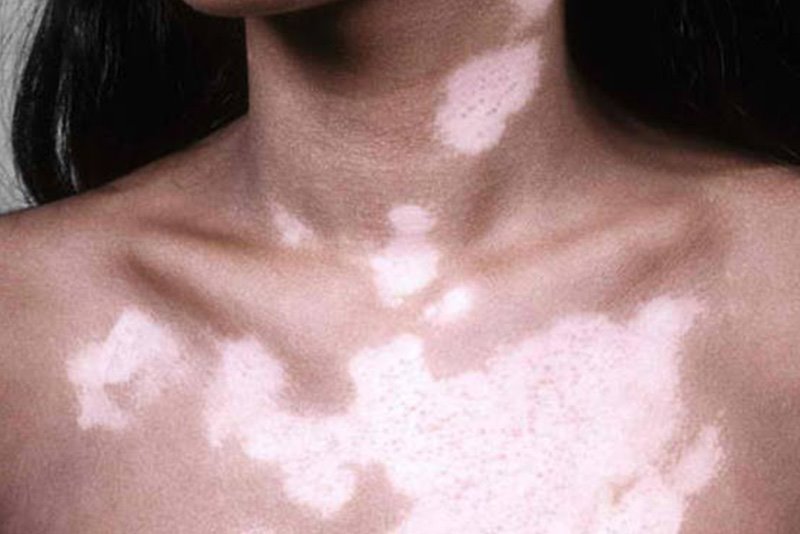 Vitiligo - Ala Hastalığı