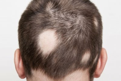 Saçkıran - Alopecia Areata