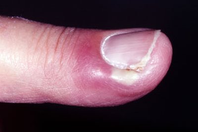 Infection In Nails- Panaris